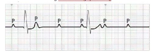 The nurse is caring for a client who has been experiencing dizziness and shortness of breath for several days. During cardiac monitoring in the emergency department (ED) , the nurse obtains the following electrocardiographictracing.   Which of the following cardiac rhythms should the nurse identify? A) Sinus rhythm with premature ventricular contractions (PVCs)  B) Junctional escape rhythm C) Third-degree atrioventricular (AV)  block D) Sinus rhythm with premature atrial contractions (PACs) 