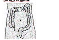 A client with a gunshot wound to the abdomen undergoes surgery, and a colostomy is formed as illustrated. Which of the following information should the nurse include in client teaching?   A) This type of colostomy is usually temporary. B) Soft, formed stool can be expected as drainage. C) Stool will be expelled from both ostomy stomas. D) Irrigations can regulate drainage from the stomas.