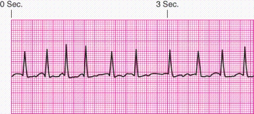 Identify the rhythm.   A)  Junctional escape rhythm B)  Atrial fibrillation C)  Unifocal premature ventricular contractions D)  Ventricular tachycardia