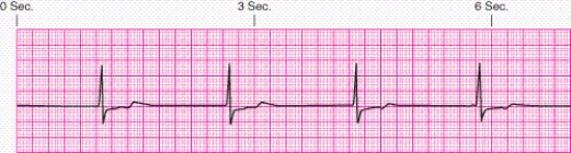 Identify the rhythm.   A)  Junctional escape rhythm B)  Atrial fibrillation C)  Unifocal premature ventricular contractions D)  Ventricular tachycardia