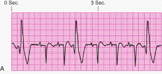 Identify the rhythm.   A)  Junctional escape rhythm B)  Atrial fibrillation C)  Unifocal premature ventricular contractions D)  Ventricular tachycardia