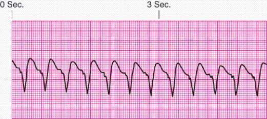 Identify the rhythm.   A)  Junctional escape rhythm B)  Atrial fibrillation C)  Unifocal premature ventricular contractions D)  Ventricular tachycardia