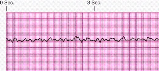 Identify the rhythm.   A)  Ventricular tachycardia B)  Ventricular fibrillation C)  Supraventricular tachycardia D)  Torsades de pointes