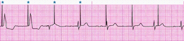 Identify complications with the above rhythm strip.   A)  Undersensing from a pacemaker B)  Oversensing from a pacemaker C)  ICD firing caused by VF D)  Atrial pacing failure to capture