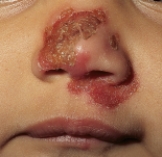 A school nurse assesses a case of tinea capitis (ringworm)  on a 6-year-old child. Which figure depicts the characteristic lesion of tinea capitis? A)    B)    C)    D)   