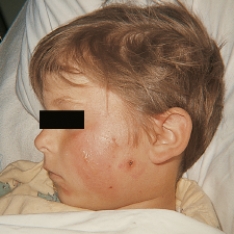 A school nurse assesses a case of tinea capitis (ringworm)  on a 6-year-old child. Which figure depicts the characteristic lesion of tinea capitis? A)    B)    C)    D)   