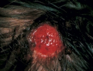 A school nurse assesses a case of tinea capitis (ringworm)  on a 6-year-old child. Which figure depicts the characteristic lesion of tinea capitis? A)    B)    C)    D)   