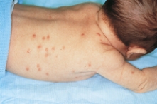 A school nurse assesses a case of tinea capitis (ringworm)  on a 6-year-old child. Which figure depicts the characteristic lesion of tinea capitis? A)    B)    C)    D)   