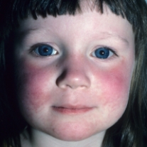 A clinic nurse is assessing a child with erythema infectiosum (fifth disease) . Which figure depicts the rash the nurse should expect to assess? A)    B)    C)    D)   