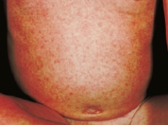 A clinic nurse is assessing a child with erythema infectiosum (fifth disease) . Which figure depicts the rash the nurse should expect to assess? A)    B)    C)    D)   