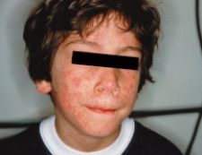 A clinic nurse is assessing a child with erythema infectiosum (fifth disease) . Which figure depicts the rash the nurse should expect to assess? A)    B)    C)    D)   