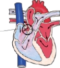 <strong>The nurse is admitting a child with coarctation of the aorta. Which figure depicts this congenital heart defect?</strong> A) B) C) D)
