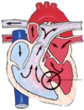 <strong>The nurse is admitting a child with coarctation of the aorta. Which figure depicts this congenital heart defect?</strong> A) B) C) D)