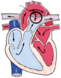 <strong>The nurse is admitting a child with coarctation of the aorta. Which figure depicts this congenital heart defect?</strong> A) B) C) D)