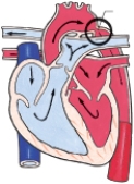 <strong>The nurse is admitting a child with coarctation of the aorta. Which figure depicts this congenital heart defect?</strong> A) B) C) D)