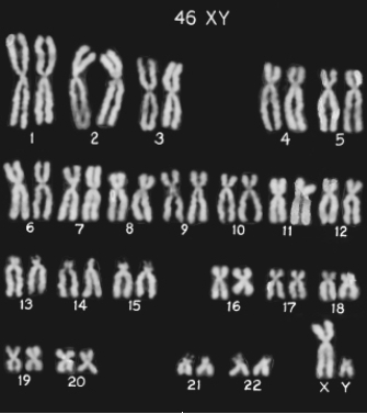 What is the name of the figure shown below that depicts the staining and photographing of an entire set of duplicated, condensed chromosomes from a single cell?   A)  Cytosmear B)  Karyogram C)  Karyotype D)  Pap smear E)  Cell smear