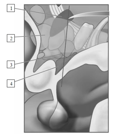  (see Figure 9.18a)  The structure indicated by #1 in this illustration is the   A)  arcuate nucleus. B)  VMH. C)  lateral hypothalamus. D)  paraventricular nucleus (PVN) .