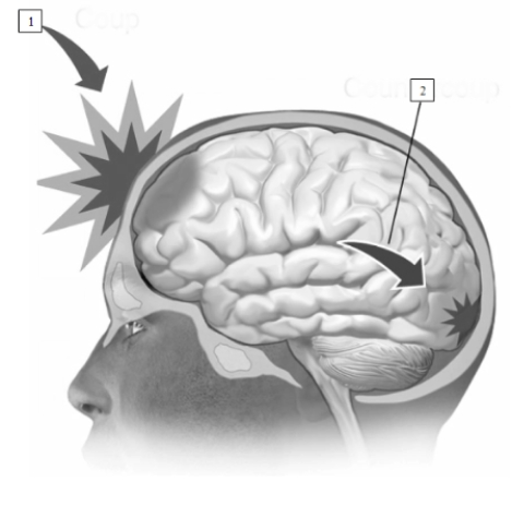  (see Figure 15.6) The initial area of impact in a closed head injury, indicated by the #____________________, is known as a ____________________. A secondary area of impact, indicated by the #____________________, is known as the ____________________.   