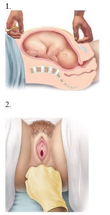 A pregnant client is having pelvimetry measurements made. Which diagram should the nurse use to demonstrate the technique for determining the anteroposterior diameter?    <div style=padding-top: 35px> 