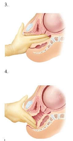 A pregnant client is having pelvimetry measurements made. Which diagram should the nurse use to demonstrate the technique for determining the anteroposterior diameter?    <div style=padding-top: 35px> 