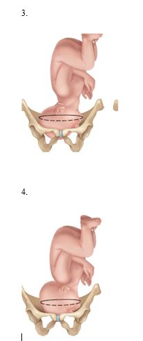 The nurse is reviewing the different types of fetal presentations with a client nearing the end of her pregnancy. Which presentation should the nurse identify as being ideal?    <div style=padding-top: 35px> 
