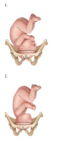 The nurse is reviewing the different types of fetal presentations with a client nearing the end of her pregnancy. Which presentation should the nurse identify as being ideal?    <div style=padding-top: 35px> 