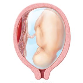 The nurse selects the following diagram to instruct a pregnant client with placenta previa. What should the nurse specifically teach the client about this health problem?Shape_   A)  The edge of the placenta is covered. B)  The placenta completely covers the internal os. C)  The placenta is implanted with partial covering of the internal os. D)  The placenta is implanted in the lower uterine segment not covering the os. 