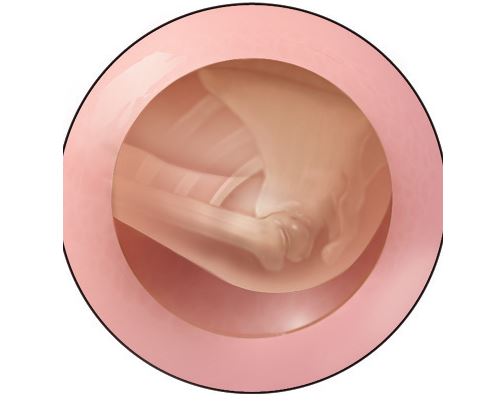 The nurse palpates the following when conducting a vaginal assessment on a client in labor:Shape_   What action should the nurse take to address this finding? A)  Position the client on the left side. B)  Prepare the client for cesarean section. C)  Place a wedge under the client's right hip. D)  Increase intravenous fluids and apply oxygen. 