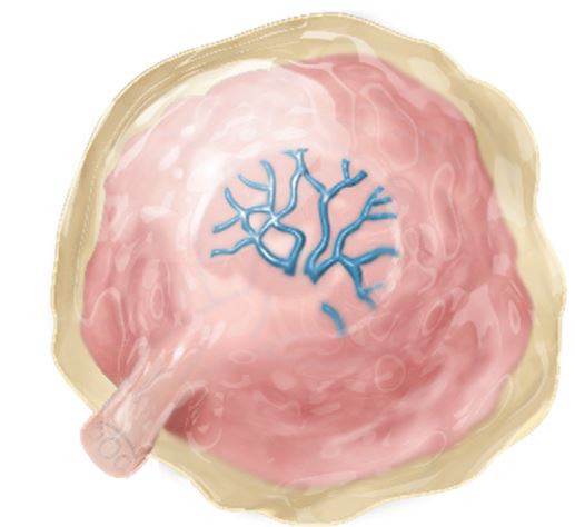 The nurse is preparing instruction on placental and umbilical cord variations. Which diagram should the nurse use to explain succenturiate placenta?  A)     B)     C)     D)    