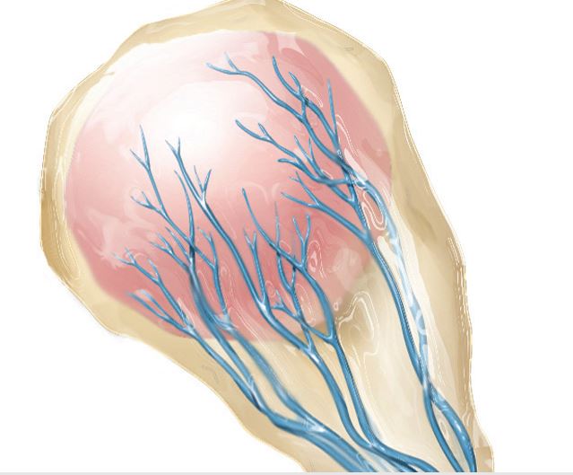The nurse is preparing instruction on placental and umbilical cord variations. Which diagram should the nurse use to explain succenturiate placenta?  A)     B)     C)     D)    