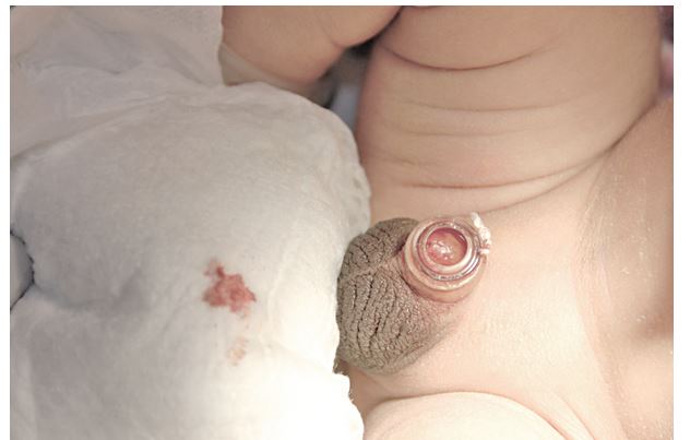 The nurse is caring for a newborn with the following device:   What should be included when instructing the parents about the newborn's care? Select all that apply. A)  The device should fall off in 8 days. B)  Apply petroleum jelly to the site after the device falls off. C)  Clean with warm water and mild soap after each diaper change. D)  Apply light pressure with a sterile gauze pad if bleeding occurs. E)  Abstain from applying cream or ointment while the device is present. 