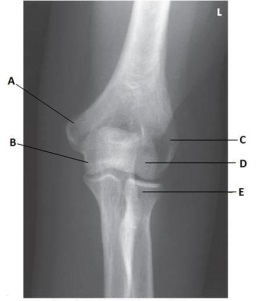 What projection is depicted in the image below?   A)  AP B)  AP oblique in medial rotation C)  AP oblique in lateral rotation D)  Mediolateral