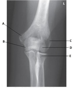 What anatomy is labeled as letter A in the image below?   A)  Lateral epicondyle of the humerus B)  Medial epicondyle of the humerus C)  Coronoid process of the ulna D)  Trochlea