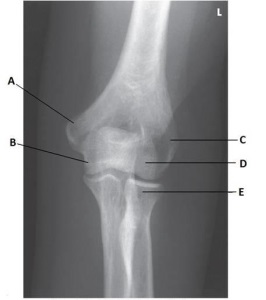 What anatomy is labeled as letter B in the image below?   A)  Lateral epicondyle of the humerus B)  Medial epicondyle of the humerus C)  Coronoid process of the ulna D)  Trochlea