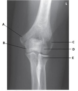 What anatomy is labeled as letter C in the image below?   A)  Lateral epicondyle of the humerus B)  Medial epicondyle of the humerus C)  Coronoid process of the ulna D)  Trochlea