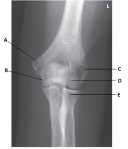 What anatomy is labeled as letter D in the image below?   A)  Lateral epicondyle of the humerus B)  Medial epicondyle of the humerus C)  Capitulum D)  Trochlea