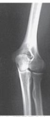 What projection and position is depicted in the image below?   A)  AP; anatomic position B)  AP oblique; lateral rotation position C)  AP oblique, medial rotation position D)  Mediolateral, lateral position