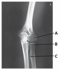 Letter A in the image below labels the:   A)  medial epicondyle of the humerus. B)  capitulum. C)  radial head. D)  trochlea.