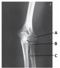 Letter B in the image below labels the:   A)  medial epicondyle of the humerus. B)  capitulum. C)  radial head. D)  trochlea.