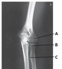 Letter C in the image below labels the:   A)  radial tuberosity. B)  capitulum. C)  radial head. D)  trochlea.