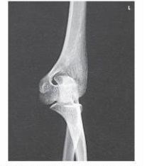 What projection and position is demonstrated in the image below?   A)  AP B)  AP oblique, medial rotation C)  AP oblique, lateral rotation D)  AP distal humerus, partial flexion position