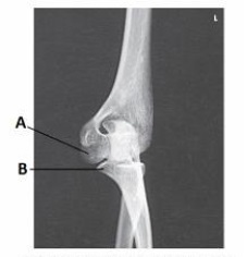 What anatomy is labeled as letter A in the image below?   A)  Capitulum B)  Lateral epicondyle of humerus C)  Trochlea D)  Coronoid process of ulna