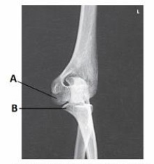 What anatomy is labeled as letter B in the image below?   A)  Capitulum B)  Lateral epicondyle of humerus C)  Trochlea D)  Coronoid process of ulna