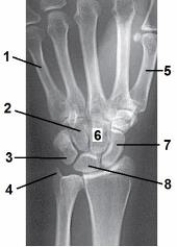What anatomy is labeled as number 1 in the image below?   A)  First metacarpal B)  Fifth metacarpal C)  Proximal phalange, fifth digit D)  Proximal phalange, first digit