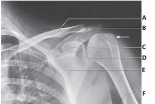 The projection in the image below was obtained with the arm positioned in:   A)  neutral position. B)  external rotation. C)  internal rotation. D)  oblique rotation.