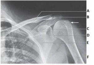 Letter A in the image below labels the:   A)  acromion. B)  coracoid process. C)  clavicle. D)  first rib.