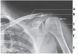 Letter B in the image below labels the:   A)  acromion. B)  coracoid process. C)  clavicle. D)  glenoid.
