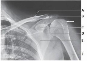 Letter C in the image below labels the:   A)  acromion. B)  coracoid process. C)  clavicle. D)  glenoid.