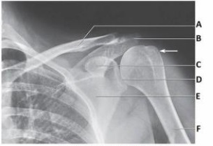 The glenoid of the scapula in the image below is labeled as letter:   A)  B. B)  C. C)  D. D)  E.