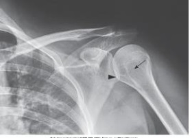 What projection, position, and anatomy of interest in the image below is demonstrated?   A)  AP projection of the shoulder in external rotation B)  AP projection of the shoulder in internal rotation C)  AP projection of the shoulder in neutral position D)  AP oblique projection of the shoulder (Grashey) 